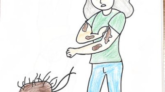 Campanha nacional Todos contra a Hanseníase - Foz do Iguaçu